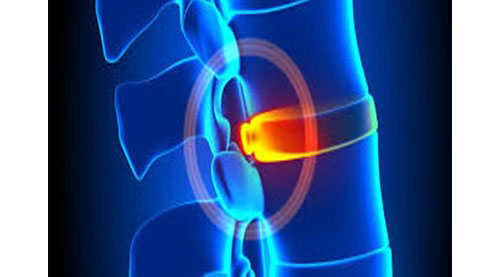 Minimally Invasive Spine Surgery